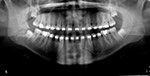 Braces