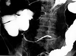 BBs in appendix
