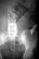 Boxcutter in bowel