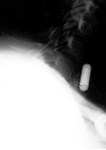 Barium capsule
