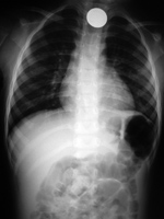 Coin in throat