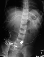Cylindrical magnets in sigmoid colon