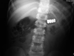 Cylindrical magnets in the stomach