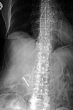 Knot in feeding tube