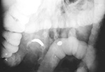 Mercury in appendiix