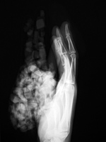 Ice bag on the hand