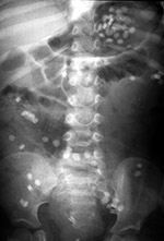 Iron pills in the bowel