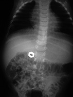 Metal nut in stomach