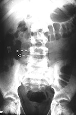 Pencil in bowel