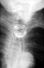 Pill cap ingestion