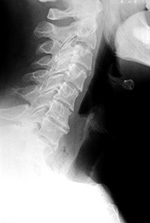 Pill cap ingestion