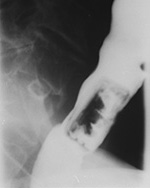 Pill cap ingestion