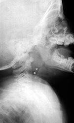 Plastic in throat