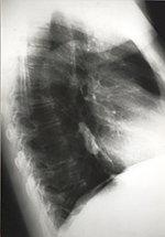 Porcelain in esophagus