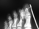 Pulse oximater on injured toe