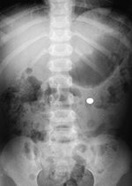 Watch battery in colon