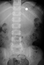 Watch battery in stomach