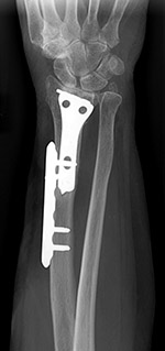 Locking dynamic compression plate