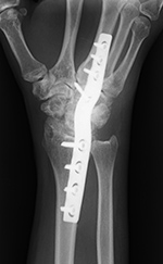 Low contact dynamic compression plate