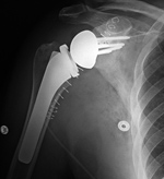 Reverse total shoulder arthroplasty
