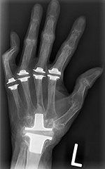 Swanson silicone joint prostheses