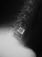 Cervical spine interverterbral disk fusion cage