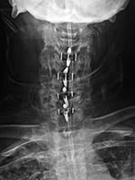 Cervical spine PEEK disk cages