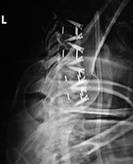 Cervical spine PEEK disk cages