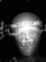 Cranial tongs AP view