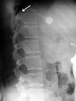 Intrathecal drug delivery catheter