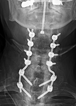 Odontoid fracture fixaton and PSF AP