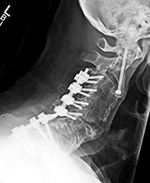 Odontoid fracture fixation and PSF lateral