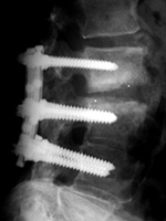 Intervertebral disk cages