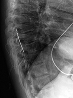 Spinal cord stimulator 