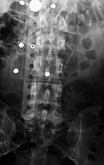 TLSO brace AP view
