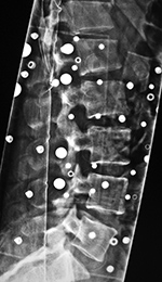 TLSO brace lateral view