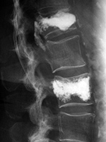 Vertebroplasty extrusion