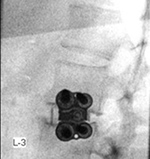XLIF lateral view