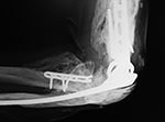 Elbow prosthesis and heterotopic bone
