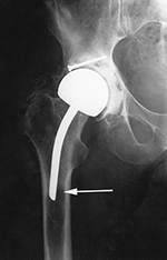 Femoral head resurfacing with osteolysis