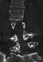 PLIF loosening coronal CT