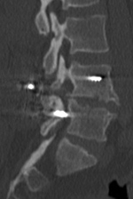 PLIF misplaced screw CT sagittal