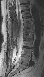 PLIF tethering of conus and seroma
