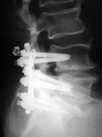 Displaced pedicle screw nut