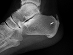 Suture anchor in calcaneus