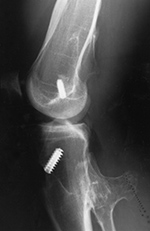 Kurosaka screw
