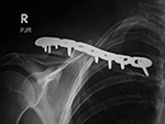 Clavicle reconstruction plate