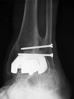 Agility Ankle Arthroplasty