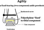 Agility ankle replacement
