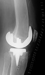 Cruciate retaining total knee prosthesis - lateral view